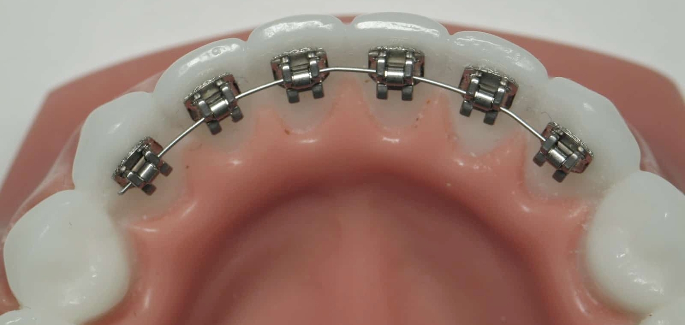 braces in mouth